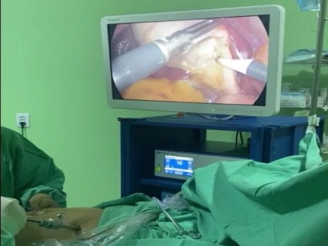 Hospital e Maternidade Santa Maria realiza cirurgias inditas por videolaparoscopia atravs do programa Cuida PE