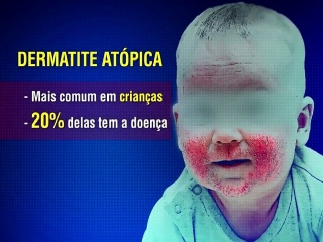 DF deve fornecer remdio de R$ 11 mil para tratar dermatite atpica