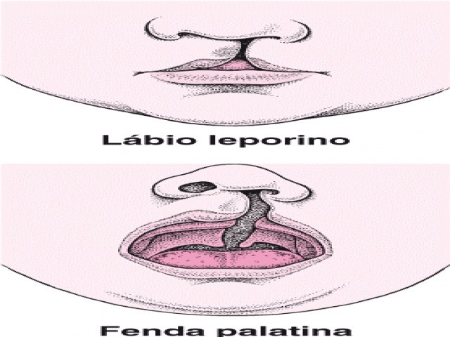 Senado aprova cirurgia reconstrutiva de lbio leporino pelo SUS