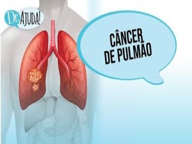Cncer de pulmo  um dos mais comuns no Brasil