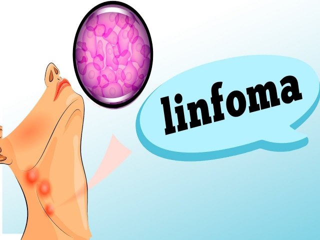 LINFOMA - Descubra os sintomas e fatores de risco