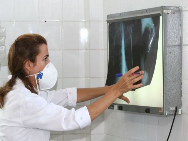 Com aumento de 5%, Brasil registra 78 mil casos de tuberculose; um aumento de 4,9%