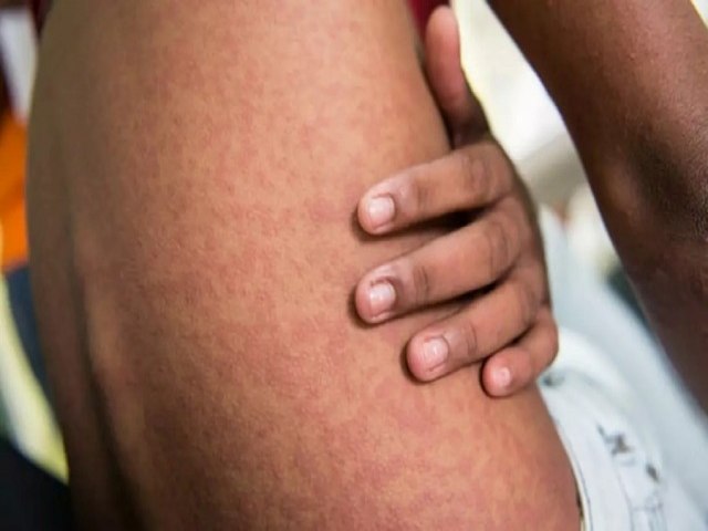 Maracaju  a segunda cidade com mais casos de Chikungunya no estado