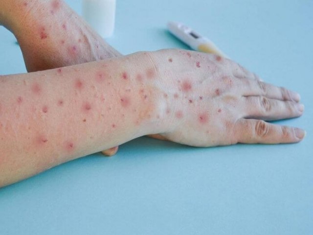 Passo Fundo registra primeiro caso de mpox em 2024