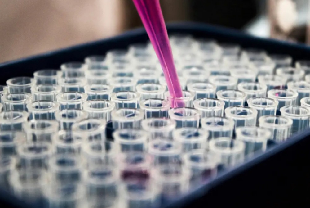 Exame de sangue promete transformar diagn�stico do Alzheimer, mas n�o � para todos.