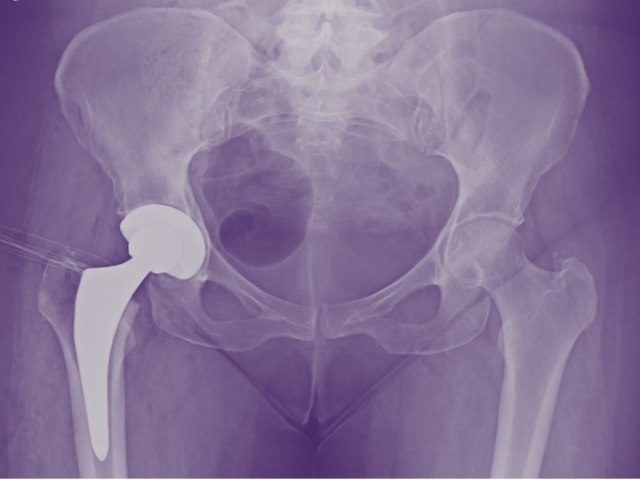 Entenda como funciona a cirurgia de prtese de quadril via anterior (AMIS)