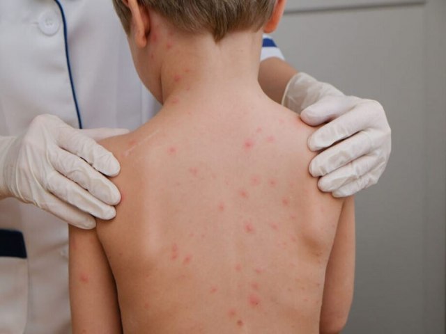 Rio de Janeiro monitora meningite meningoccica no norte do Estado