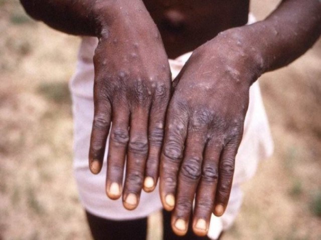 Casos de mpox disparam em 160% na frica e OMS decreta emergncia global